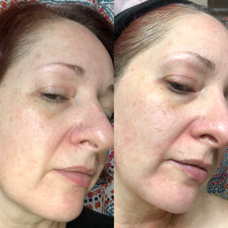 Side-by-side selfies, Differin for wrinkles, skin experiment, right side view