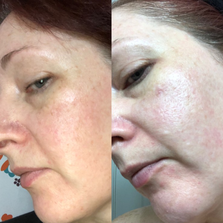 Side-by-side selfies, Differin for wrinkles, skin experiment, left side view
